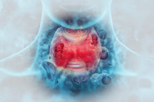 A 3D illustration of thyroid gland cancer, depicting a tumor possibly related to radiation exposure.