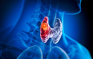 Thyroid gland with tumor caused by radiation exposure.