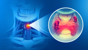 Thyroid gland cancer. 3d illustration showing thyroid gland with tumor.