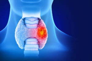 Medically accurate illustration of Thyroid gland cancer.